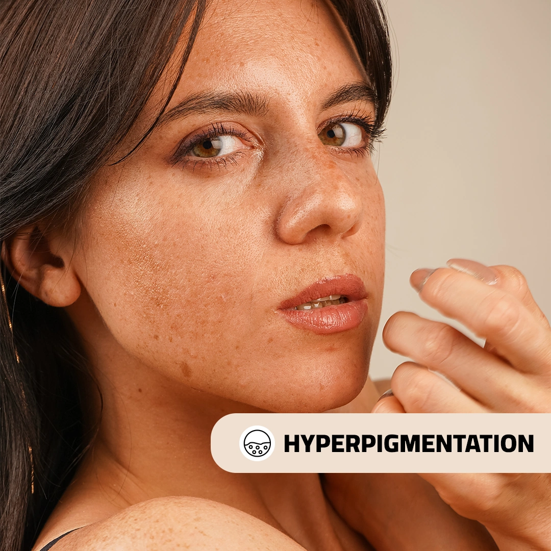 Hyperpigmentation