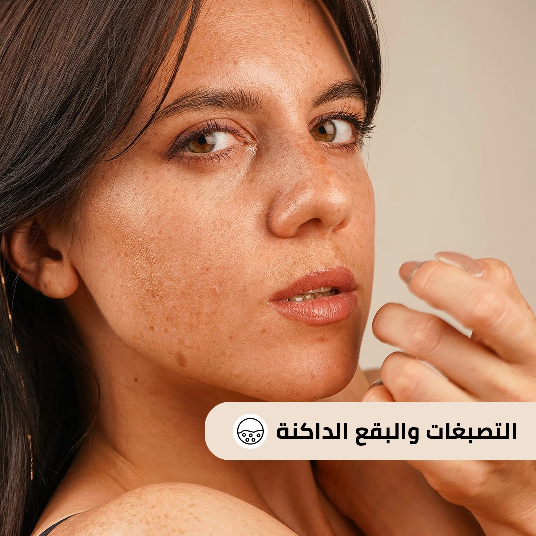 التصبغات و البقع الداكنه